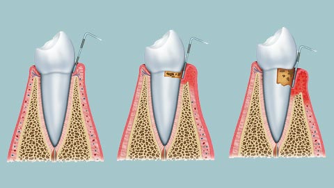 stages of gum disease