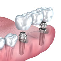 dental implants supporting a dental bridge